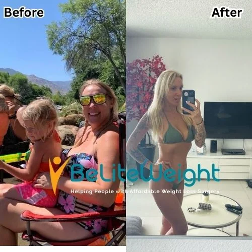 Weight Loss Surgery Before And After
